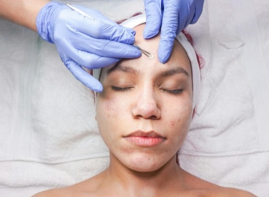 facial service for acne skin